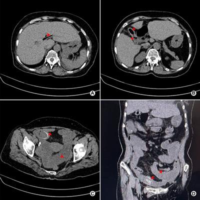 Surgical Management of Cholecystoenteric Fistula in Patients With and Without Gallstone Ileus: An Experience of 29 Cases